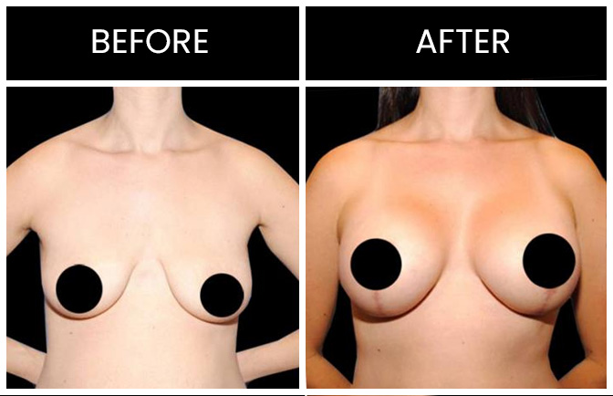 Atlanta Breast Augmentation with Lift Results